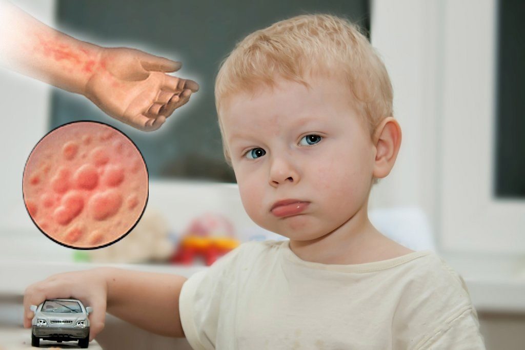 Allerjik Duyarlılığın Saptanmasında Allerji Testleri